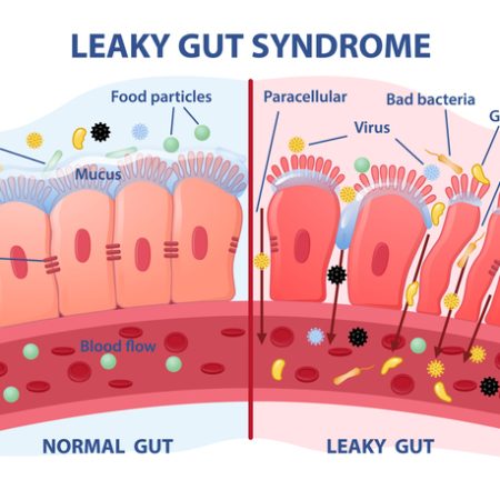 Leaky gut Syndrome concept. Comparison of healthy organ and inflamed tissue cells. Diseases of gastrointestinal tract. Toxins and viruses. Cartoon flat vector illustration isolated on white background